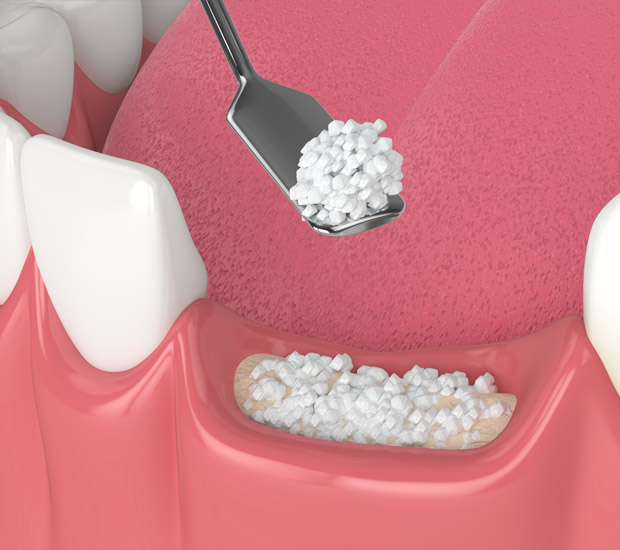 Pompano Beach Will I Need a Bone Graft for Dental Implants