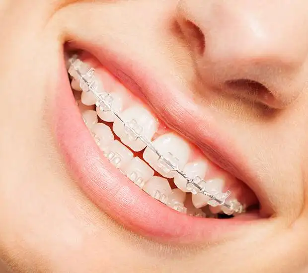 Pompano Beach Clear Braces