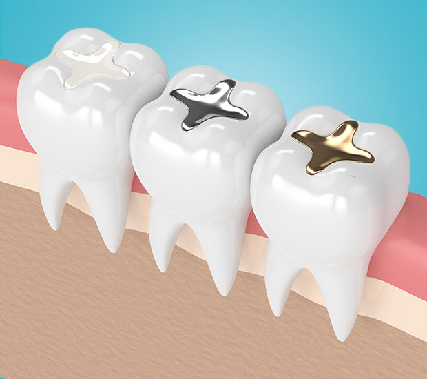 Pompano Beach Composite Fillings