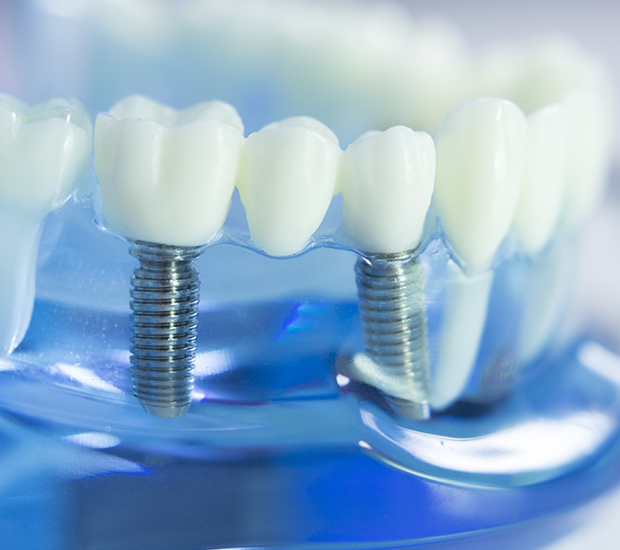 Pompano Beach Dental Implants