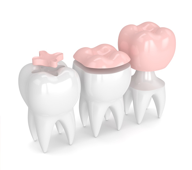 Pompano Beach Dental Inlays and Onlays