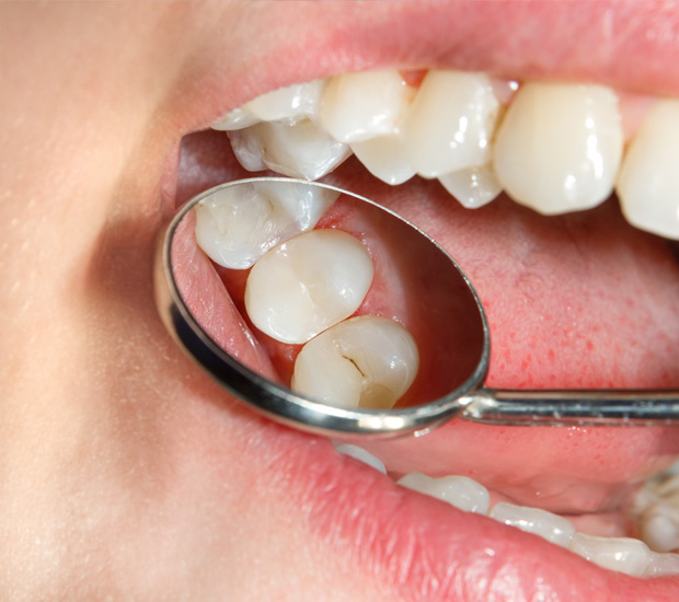 Pompano Beach Dental Sealants