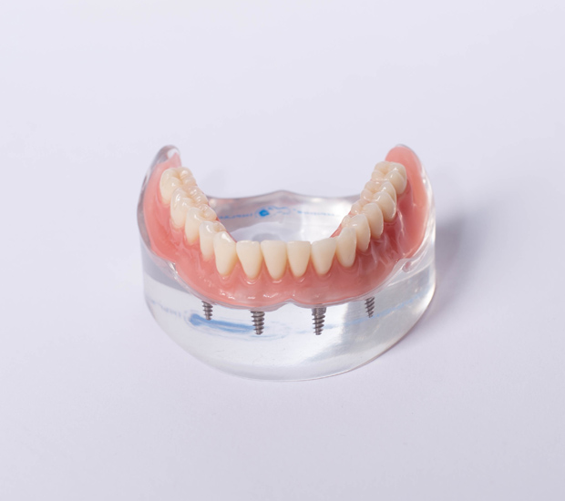 Pompano Beach Implant Supported Dentures