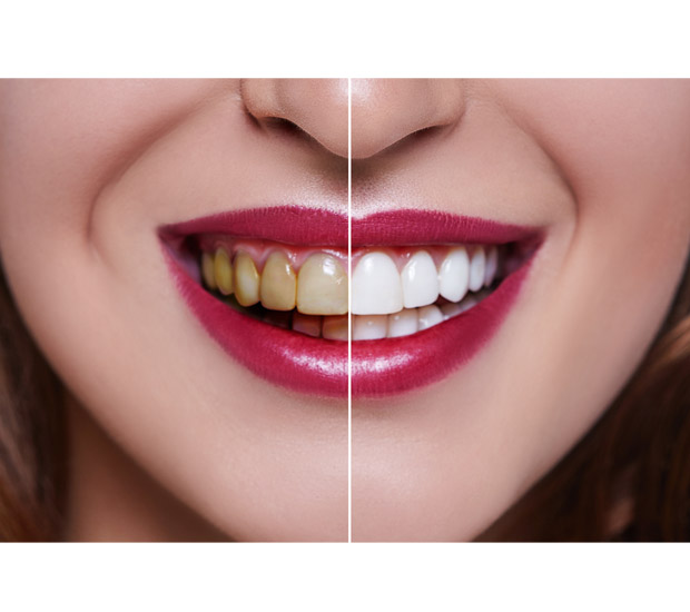 Pompano Beach Teeth Whitening at Dentist