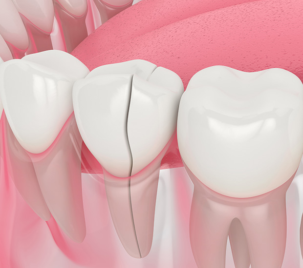 Pompano Beach Types of Dental Root Fractures